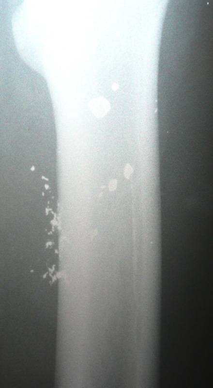 X-Ray of  Hamza Sulaiman Yasin's femur (youth in photo with combat trousers) showing bullet's penetration of  bone and surrounding bone debris