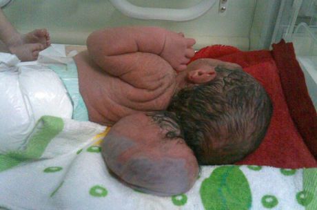  Multiple birth defects, many as severe as this, have become common with babies born in the aftermath of US assaults on the city (Dr Samira Alani/Al Jazeera)